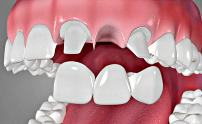 Dental Bridge Treatment for Missing Tooth