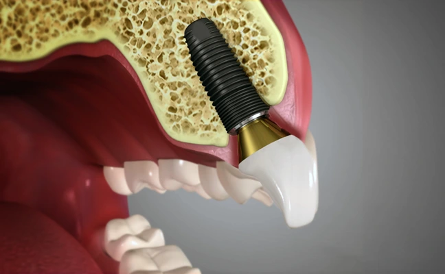 All-on-4 Dental Implants in Grand Prairie