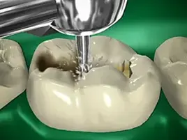 Tooth colored filling